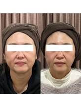 リライズ 磐田(Rerise)/オーダー小顔エステ