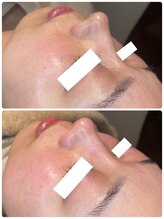 ディオーネ 春日井勝川店(Dione)/毛穴洗浄☆ビフォーアフター