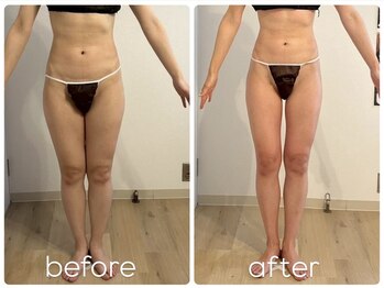 プリマ(prima)/下半身痩せ症例