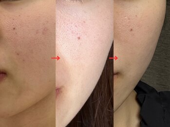 トモニ(TOMONI)/スキンケアRavissa(ラヴィーサ)