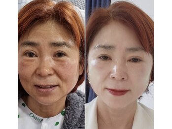 ICDスキンスタジオ 新宿三丁目(ICD-skin studio)/Before-After