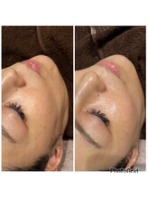 スペチアーレ 夙川/炭酸ピーリングでぷるぷるモチ肌