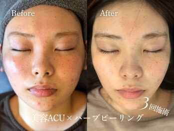 ザ エヌ(The N)/ハーブピーリングセット人気です