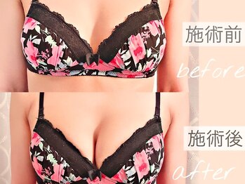 バスト専門店 フェリーチェ 新宿店(FALICE)/バストアップ/ビフォーアフター