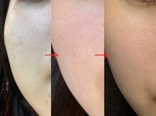 トモニ(TOMONI)/スキンケアRavissa(ラヴィーサ)