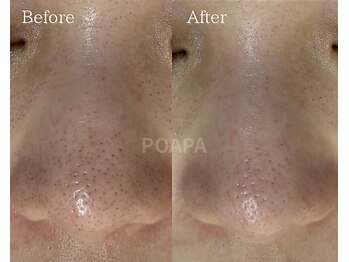 ポアラ(POARA)/毛穴/ワックス脱毛