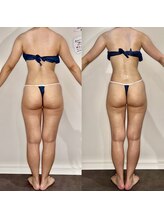 カルナ(CARNA)/【痩身】セルライトゼロ2