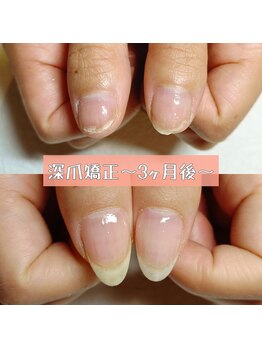 傷んでいたお爪に深爪矯正