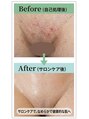 アルモ(ALMO) ※イメージ画像。個人差あります。サロンケアで滑らかな美肌に。