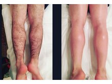 アート 熊本並木坂店(ART)/フラッシュワックス脱毛/脚全体