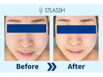 ストラッシュ 京都店(STLASSH)/施術例:小鼻