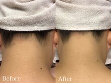 ラウレア 西条店(LAULEA)/襟足脱毛6回