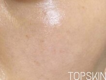 トップスキン 名駅(TOPSKIN)/名古屋ハーブピーリング専門店