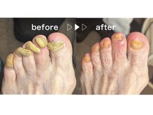 フットアドバンス 成城店/爪カット（肥厚調整含む）