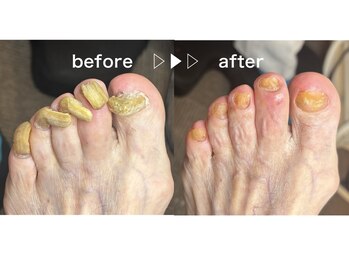 フットアドバンス 成城店/爪カット（肥厚調整含む）