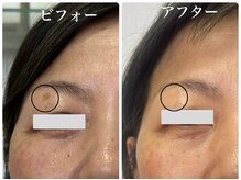 『目立っていたまぶたのシミが見当たらない！』