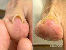 コバコ(kobaco)/巻き爪ケア　初回