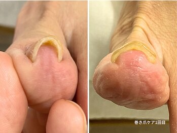 コバコ(kobaco)/巻き爪ケア　初回