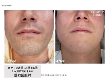 メンズスキンラボ(MEN'S SKIN LABO)の写真/脱毛は男性の身だしなみの１つ!脱毛で一気に垢抜け!メンズ専門店で顔の身だしなみをトータルプロデュース◎