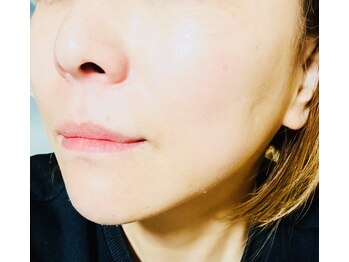 サロンモコ(Salon Moco)の写真/【30代からの肌管理】小顔エステ×水光マスクで潤ツヤ体験！内側から輝く美しさを♪