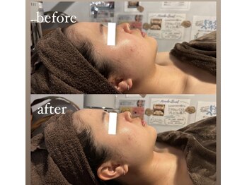 カシェット(cachette)/小顔フェイシャル