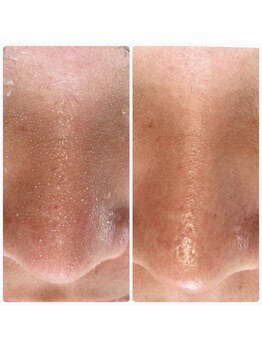 シアンビビ(Cyaan bibi)/韓国式３D毛穴洗浄