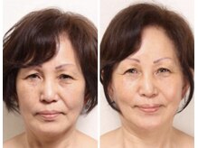 リスプリヴェ(Lis Prive)/フェイスラインをスッキリしたい