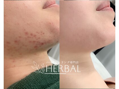 ハーバル 新宿店(HERBAL)の写真
