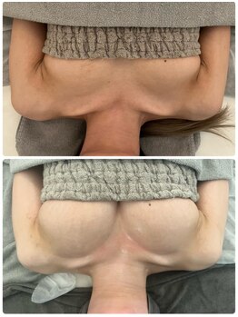 美人バスト 旭川店/バストアップ◇症例◇