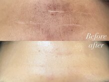 レシェルサロン(Lechelle Salon)/皮向け有ハーブピーリング