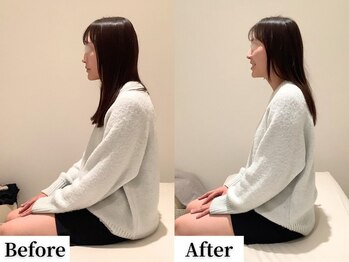 ソレア(Solea)/肩こり・巻き肩改善1回目