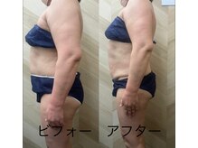 クーポノドット(Ku-pono.)/痩身エステ／ビフォーアフター