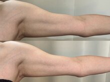 エモーショナル 姫路(Emotional)/エステ版オンダ◎マイクロボディ