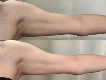 エモーショナル 姫路(Emotional)/エステ版オンダ◎マイクロボディ