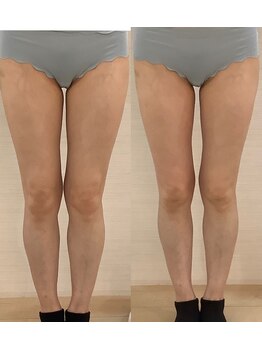 デイスパ ヴィータ/before after