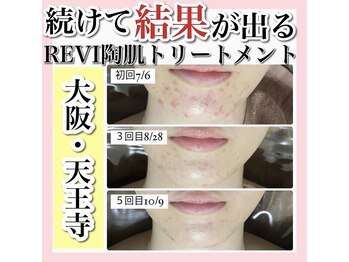 アルムダアクア 天王寺店(Aleumda AQUA)/ハーブピーリング/大阪/天王寺