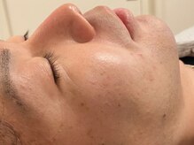 ルーナジェーナ(Luna llena)/モテたいなら、今すぐヒゲ脱毛。