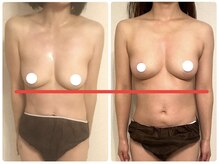 プリマ(prima)/バストアップ症例（産後バスト）