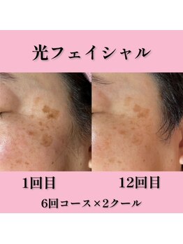 美肌脱毛エステサロン ベール 昭島店/光フェイシャル