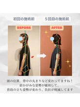 ラクリエ 姫路駅前院(La Creer)/姿勢ビフォーアフター/猫背/骨盤