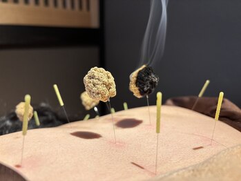 森の鍼灸院 京都下京町家院/灸頭鍼