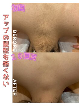 パルティノ 高崎店/全身脱毛・顔・VIO込み