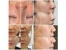 【人気No.2】サーマル麻酔付き♪ 毛穴・シミ・凹凸改善＆コラーゲン生成促進