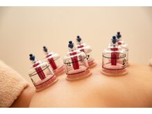 しのとう鍼灸整体院/カッピング（オプション）