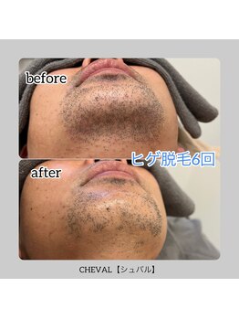 シュバル(CHEVAL)/ヒゲ脱毛6回