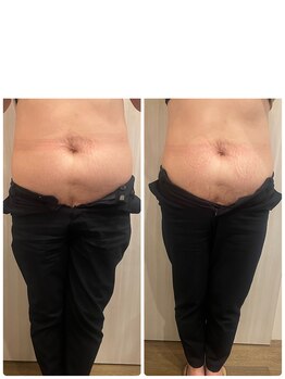 長寿鍼灸院 長寿整骨院/EMS<お腹集中コース>