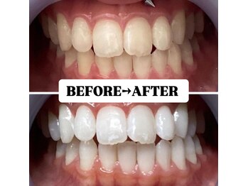 ホワイトニングサロン 豊中/詰め物があっても大丈夫！