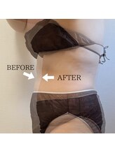 ブルーム(BLOOM)/浮き輪肉集中ケア