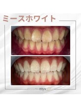 ミースホワイトニング(mys whitening)/ビフォーアフター【歯科提携】