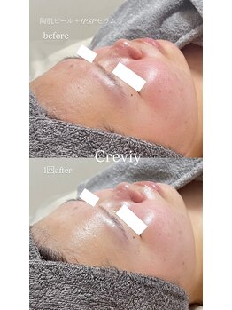 クレヴィー(Creviy)/陶肌ピール